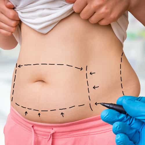 Liposuction from Vancouver to Tijuana, Mexico – Transform Your Look Abroad